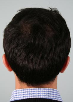 After Hair Transplant&nbsp;Crown